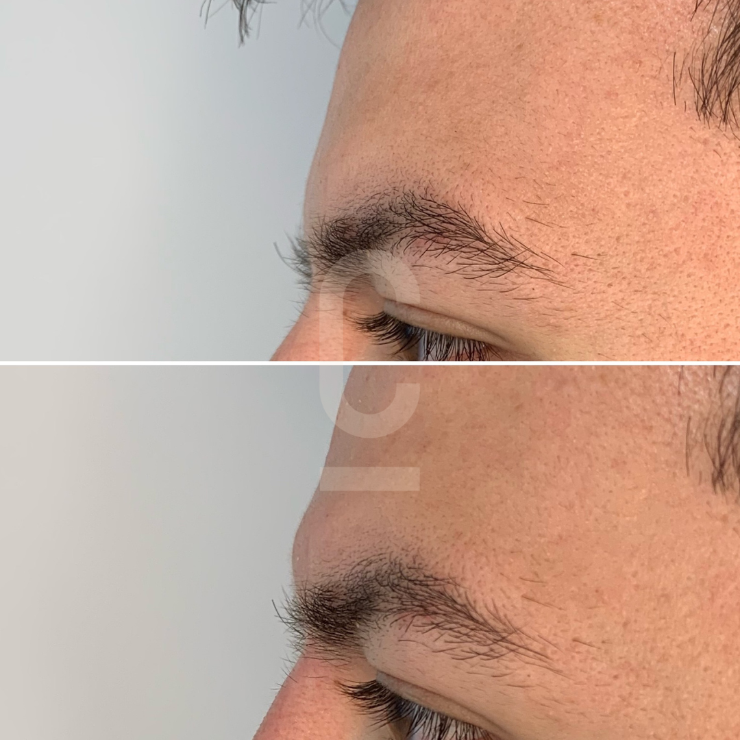 Side profile of a persons face, shown in two images. The top image shows the profile before a change, and the bottom image shows the profile after. Subtle alterations are noticeable in the brow and nose areas.