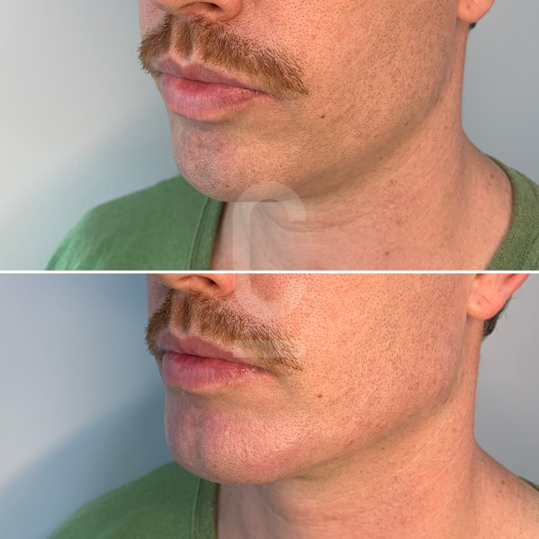 Two close-up images of a persons jawline and mustache. The top image shows subtle hair on the face, and the bottom image features smoother skin after shaving. The person is wearing a green shirt.