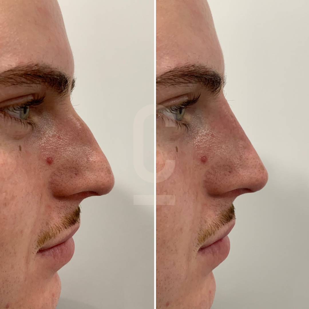 Side-by-side profile comparison of a persons nose, showing a noticeable change in shape and size. The left image depicts the nose with a bump, and the right image shows a smoother, straighter profile.