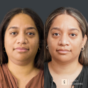 Side-by-side comparison of a woman before and after a cosmetic procedure. The first image shows her with a relaxed expression and the second with slight differences in facial features. She wears a brown top in the first and a black top in the second.