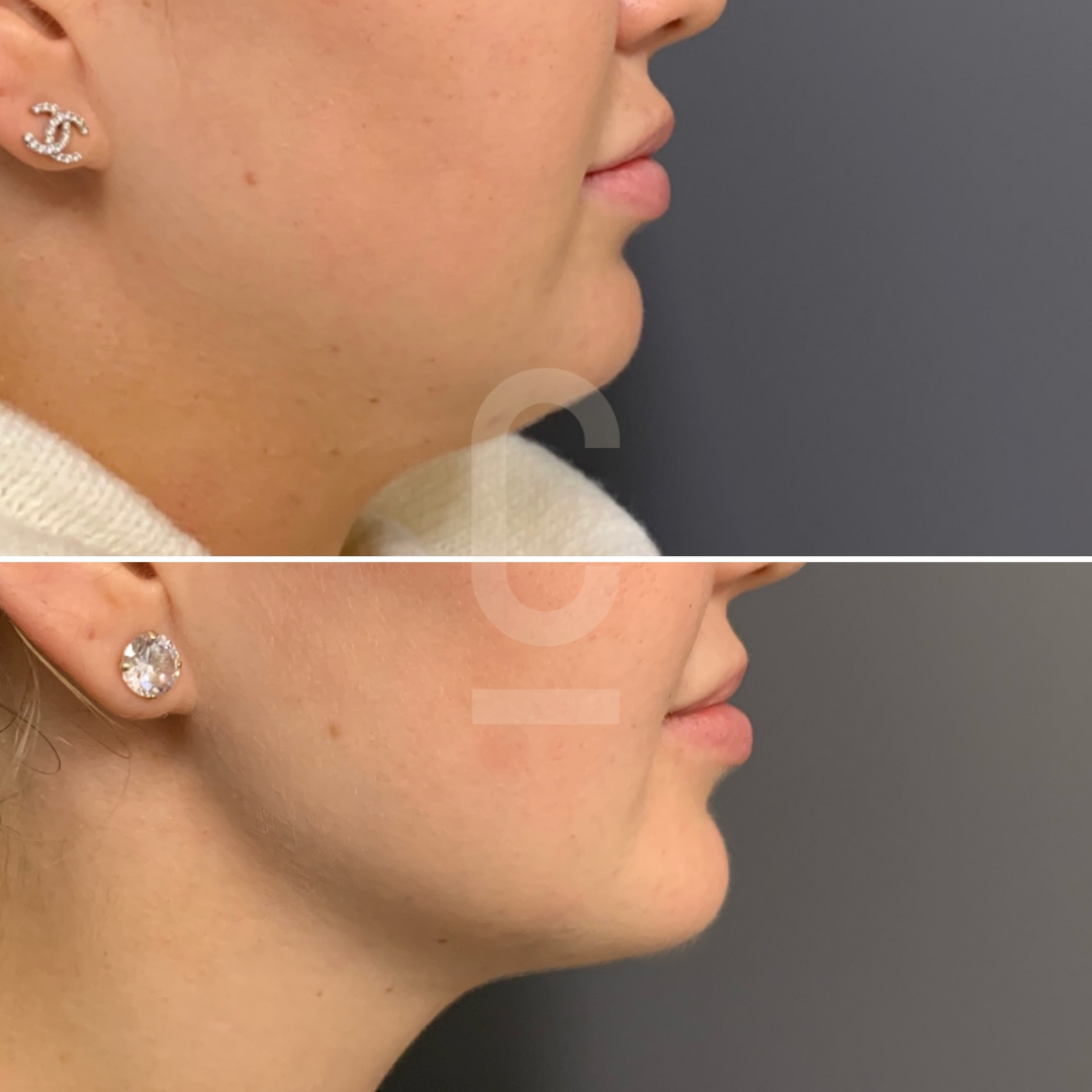 Side-by-side comparison of a persons profile before and after chin treatment. The upper image shows a slightly recessed chin, while the lower image shows a more defined chin. Both images feature the person wearing earrings.