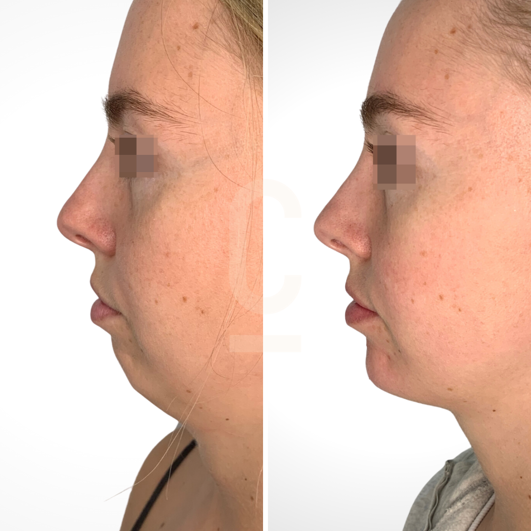 Side-by-side profile images of a persons face before and after a procedure. There is a visible difference in the contour and angle of the chin and jawline. Both images have the eyes obscured for privacy.