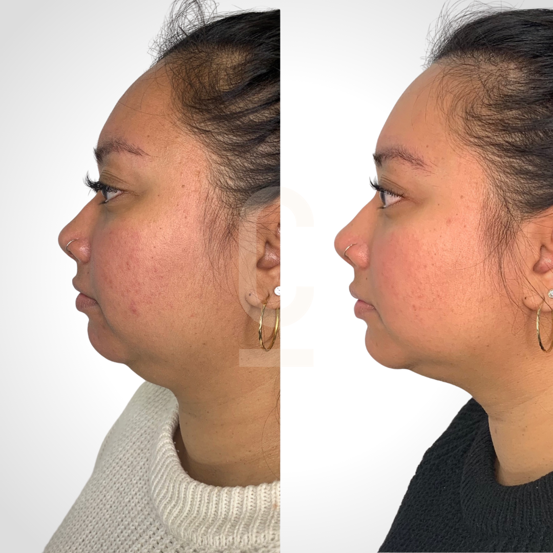 Side-by-side comparison of a persons profile before and after treatment. The left image shows a woman with some facial redness and the right image displays smoother skin. Both images show her with hair tied back and wearing hoop earrings.