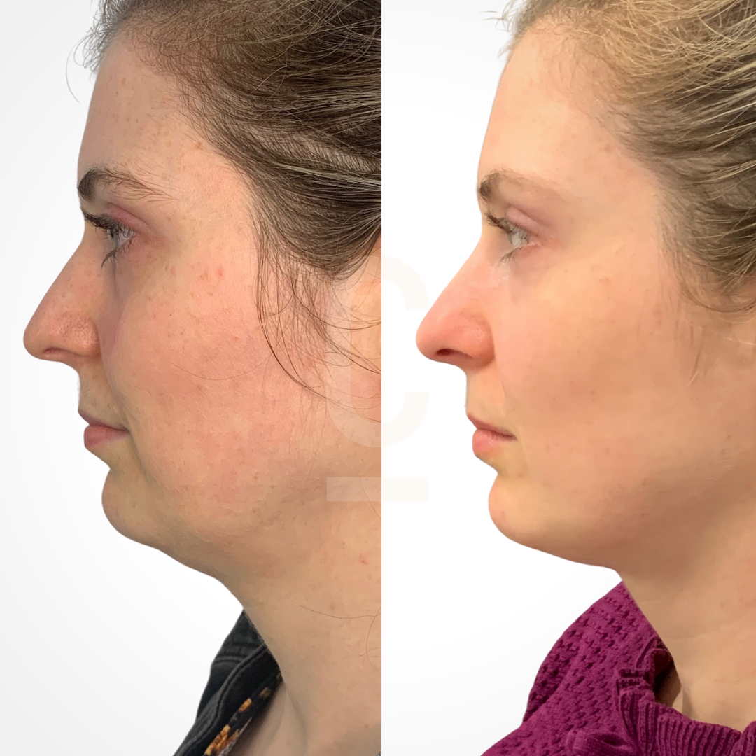 Side-by-side profile views of a persons face before and after a transformation. The before image shows a less defined jawline, and the after image shows a more contoured jawline and reduced appearance of a double chin.