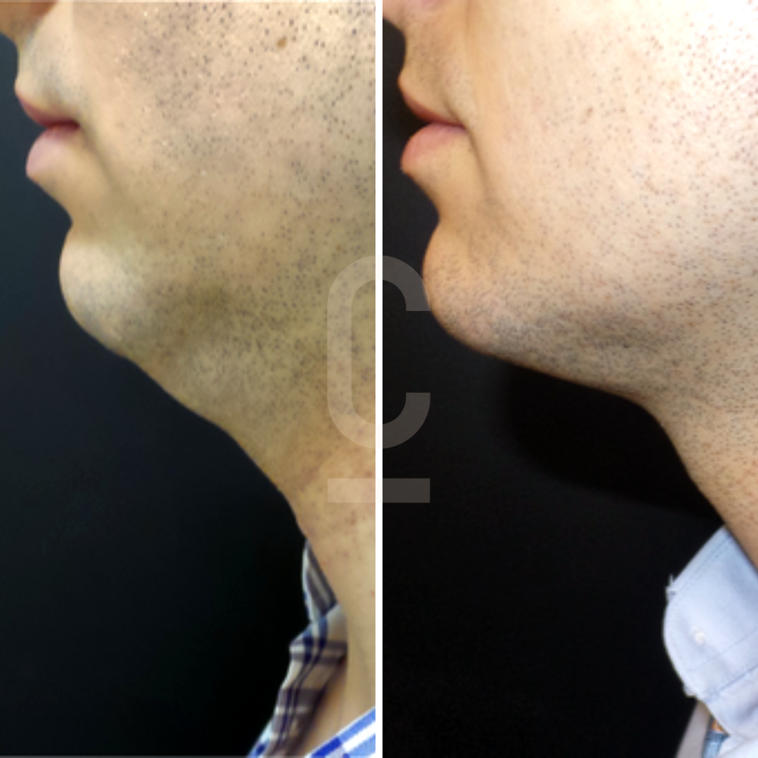 Side-by-side comparison of a persons jawline before and after treatment. The before image shows a less defined jawline, while the after image reveals a noticeably sharper and more contoured jawline.
