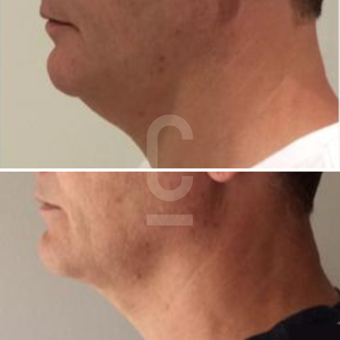 Side-by-side comparison of a persons jawline and neck, showing a visible reduction in double chin and tightening of the skin in the after image below, against a neutral background.