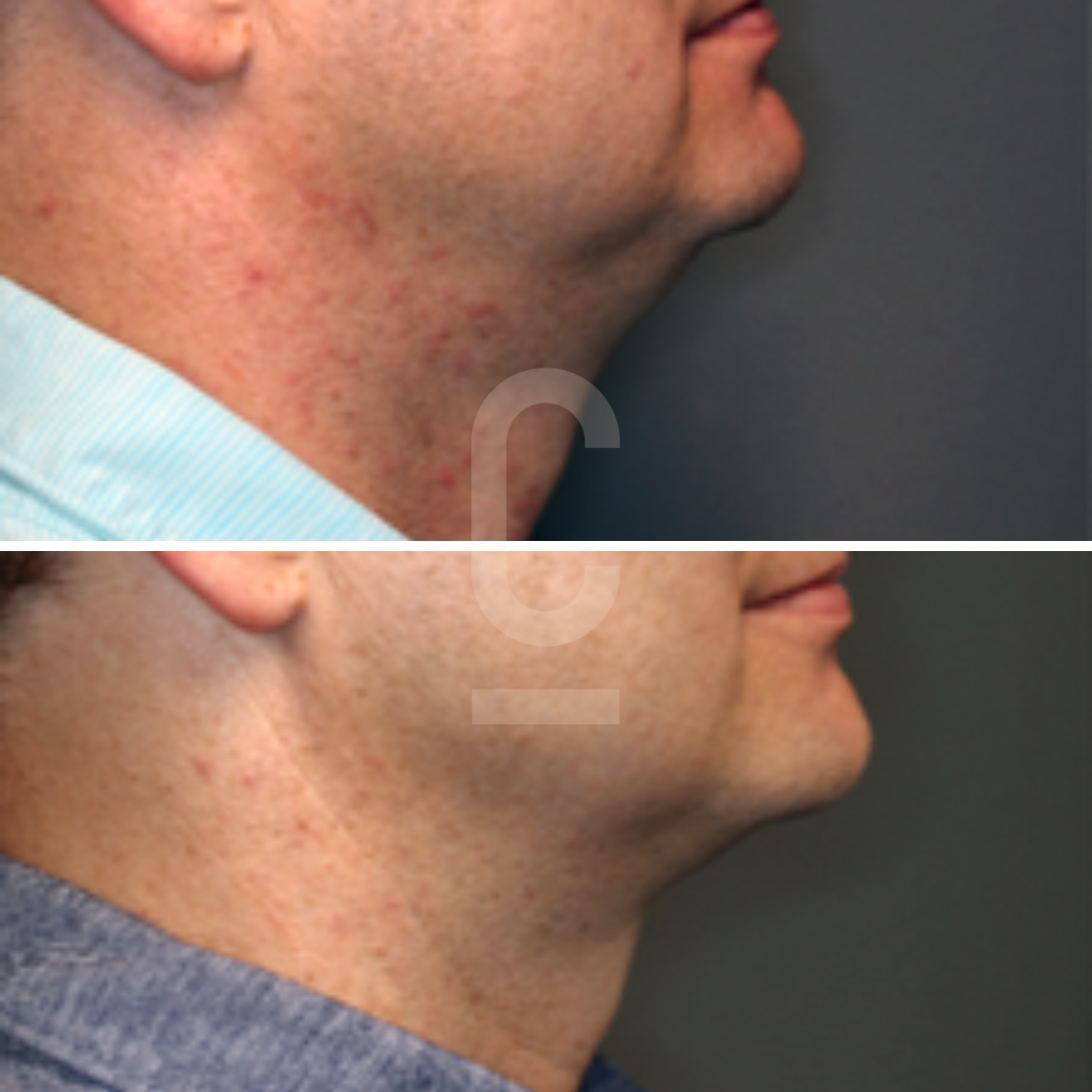 Side-by-side comparison of a persons chin and neck area before (top) and after (bottom) a treatment. The lower image shows a noticeable reduction in chin fullness. Both images include partial views of the persons shirt collars.