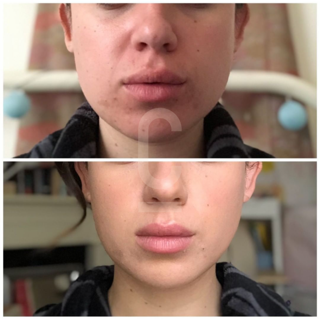 Before and after images showing a persons lower face. The top image highlights a slightly swollen or uneven lip, while the bottom image shows a more even and smooth appearance.