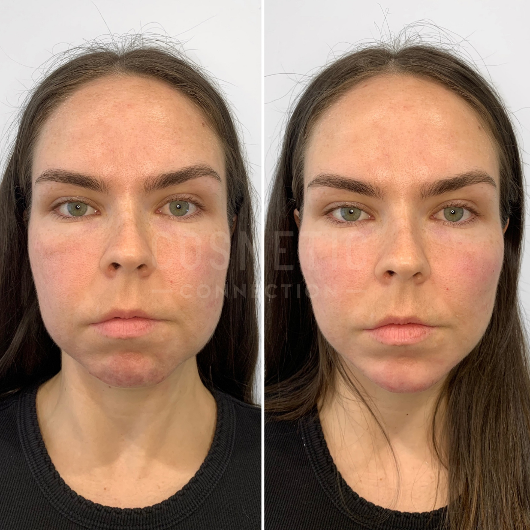 Side-by-side comparison of a womans face before (left) and after (right) a cosmetic procedure. The woman has long brown hair and is wearing a black top. The after image shows a smoother complexion with less redness.