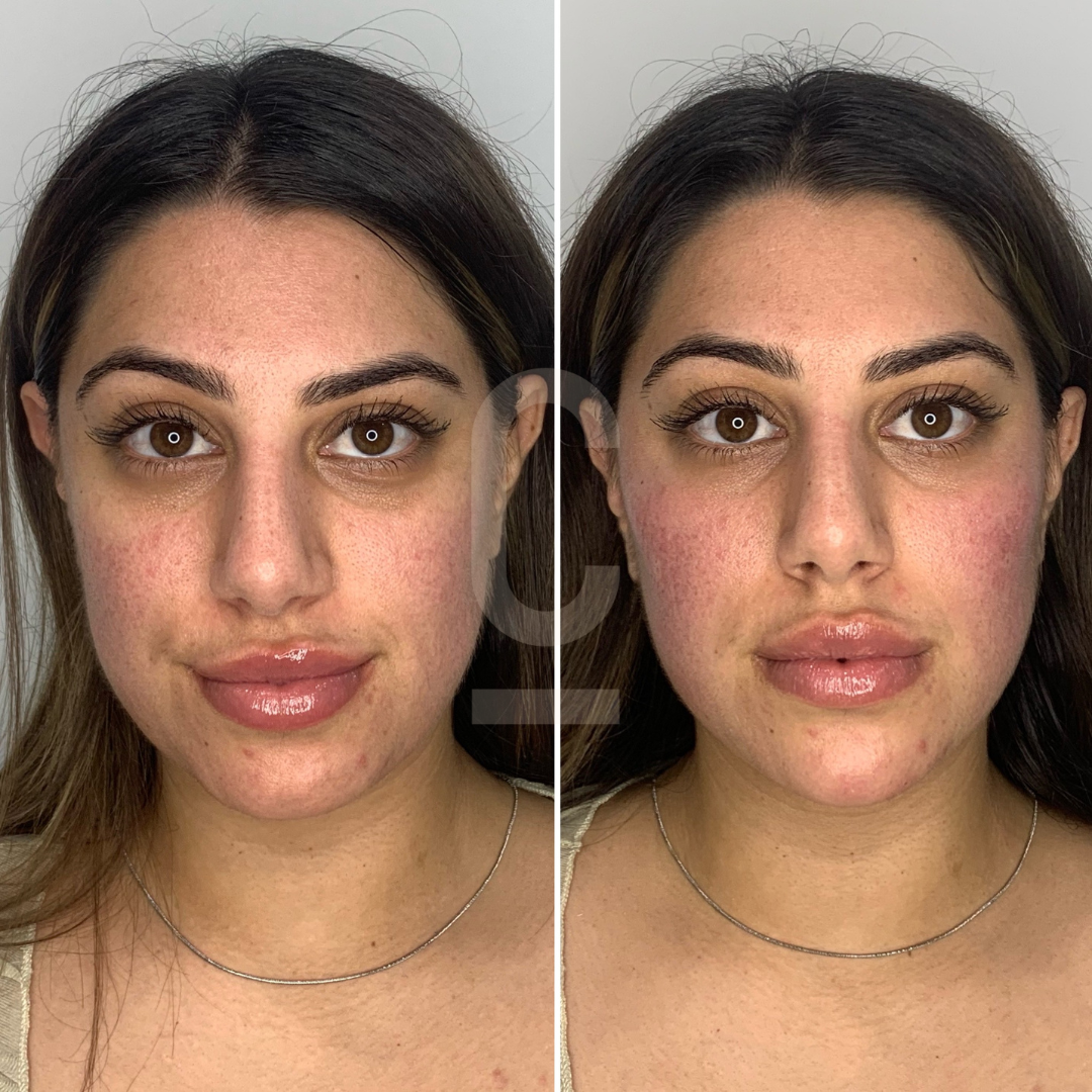 A side-by-side comparison of a woman with long, dark hair before and after a beauty treatment. Her skin appears smoother and her lips fuller on the right side. She wears a neutral expression in both images.