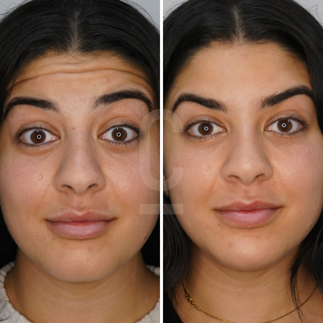 Side-by-side comparison of a womans face before and after treatment. The left image shows more visible skin blemishes and uneven tone, while the right image appears smoother and more even-toned.