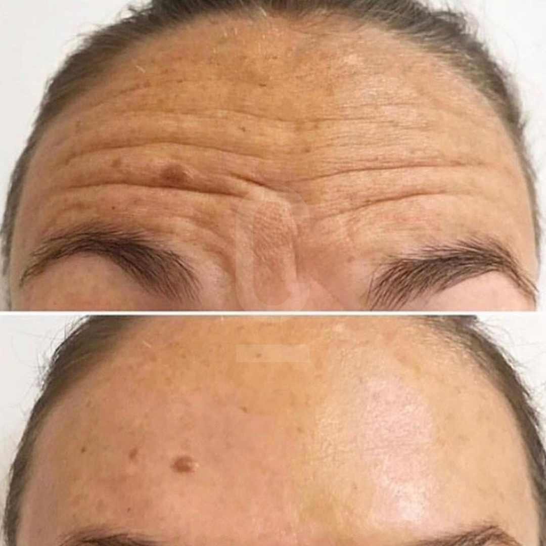 Close-up of a forehead with noticeable lines and wrinkles in the top image, and a smoother, wrinkle-free appearance in the bottom image.
