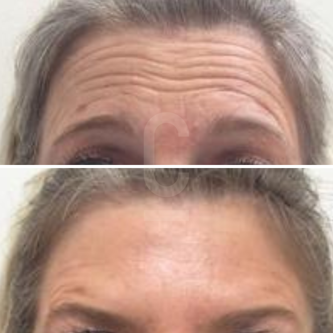 Close-up comparison of a persons forehead with noticeable wrinkles in the top image and smoother skin in the bottom image, likely showing results of a cosmetic treatment.