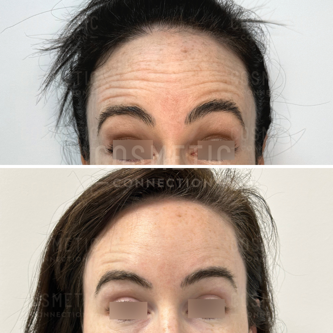 Close-up images showing a womans forehead and eyebrows before and after a cosmetic procedure. The top image shows pronounced forehead wrinkles, while the bottom image shows a smoother appearance. Eyes are obscured for privacy.