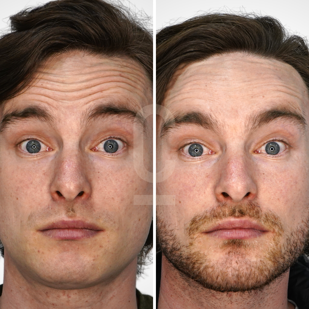 Side-by-side images of a man before and after treatment. The left shows him with forehead lines and clean-shaven, while the right depicts him with smoother skin and stubble. He has blue eyes and a neutral expression in both images.