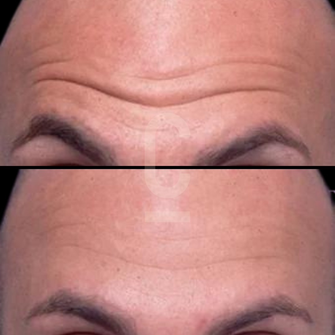 Close-up image comparing a persons forehead before and after a treatment. The top half shows a forehead with visible wrinkles, while the bottom half shows a smoother forehead with reduced lines. The focus is on the skin texture and wrinkle reduction.