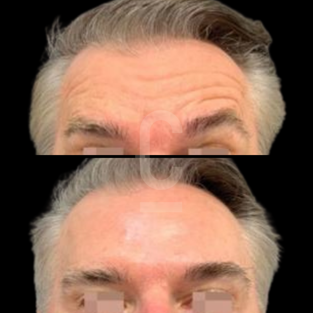 Before and after comparison image showing a mans forehead. The top half displays visible wrinkles, while the bottom half shows a smoother, wrinkle-free appearance.