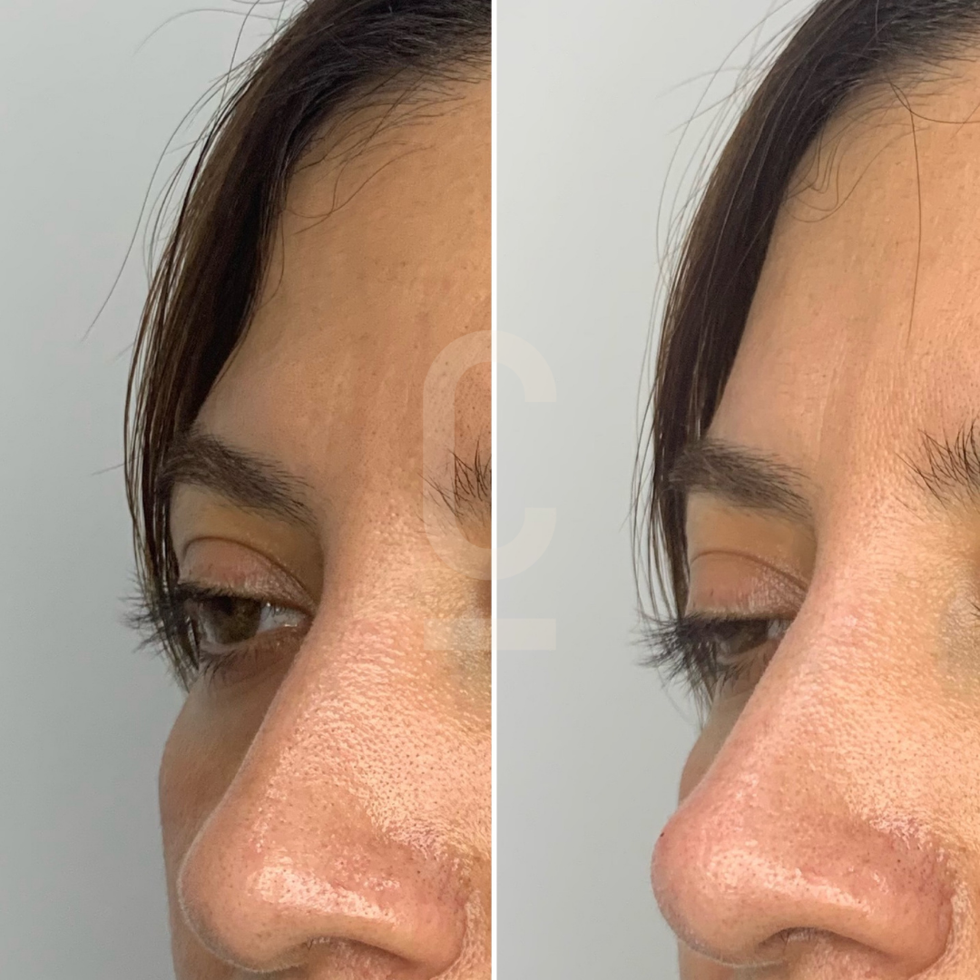 Side-by-side comparison of a womans profile showing the before and after of a cosmetic procedure. The left shows a slight nasal bump, while the right displays a smoother contour.