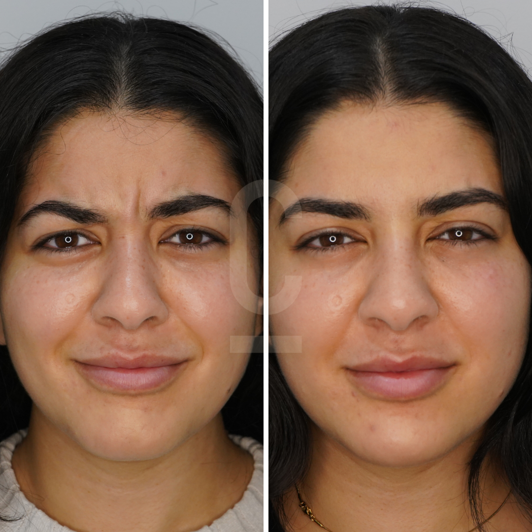 Side-by-side comparison of a womans face before and after an aesthetic treatment. On the left, she has a slight frown; on the right, her expression is relaxed. Her skin appears smoother in the after image.