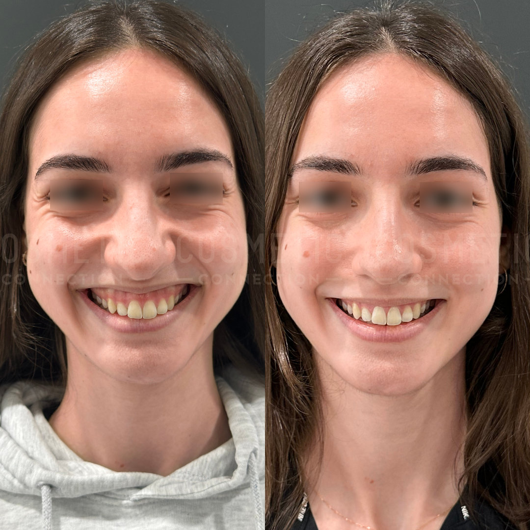 Side-by-side photos of a young woman show a comparison before and after a cosmetic procedure. In each, shes smiling broadly. The left image may show her before treatment, while the right shows the results with a more refined appearance.