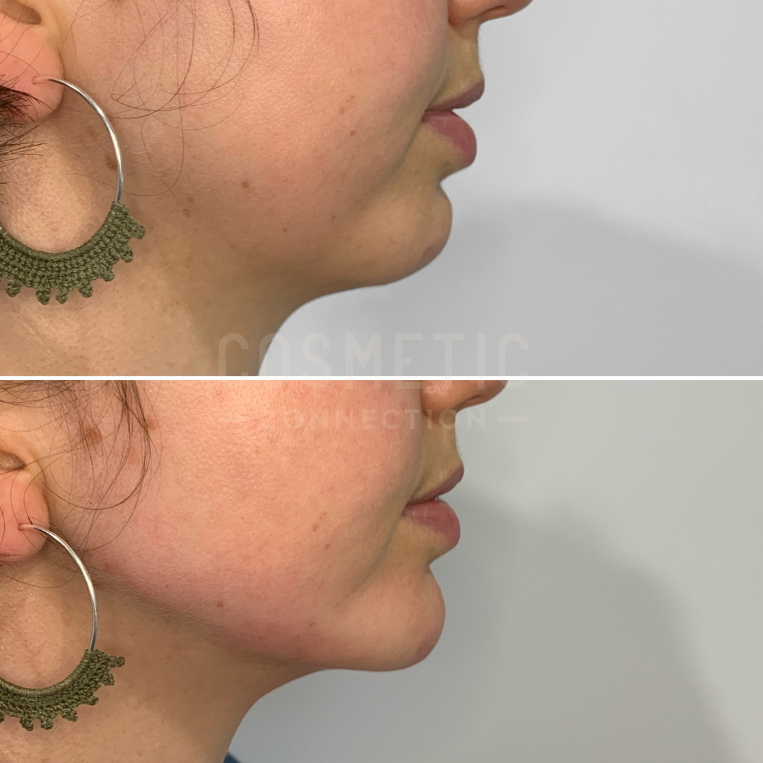 Side-by-side comparison of a persons jawline before and after a procedure. The top image shows a fuller chin area while the bottom image reveals a more contoured profile. The person is wearing large, circular earrings.