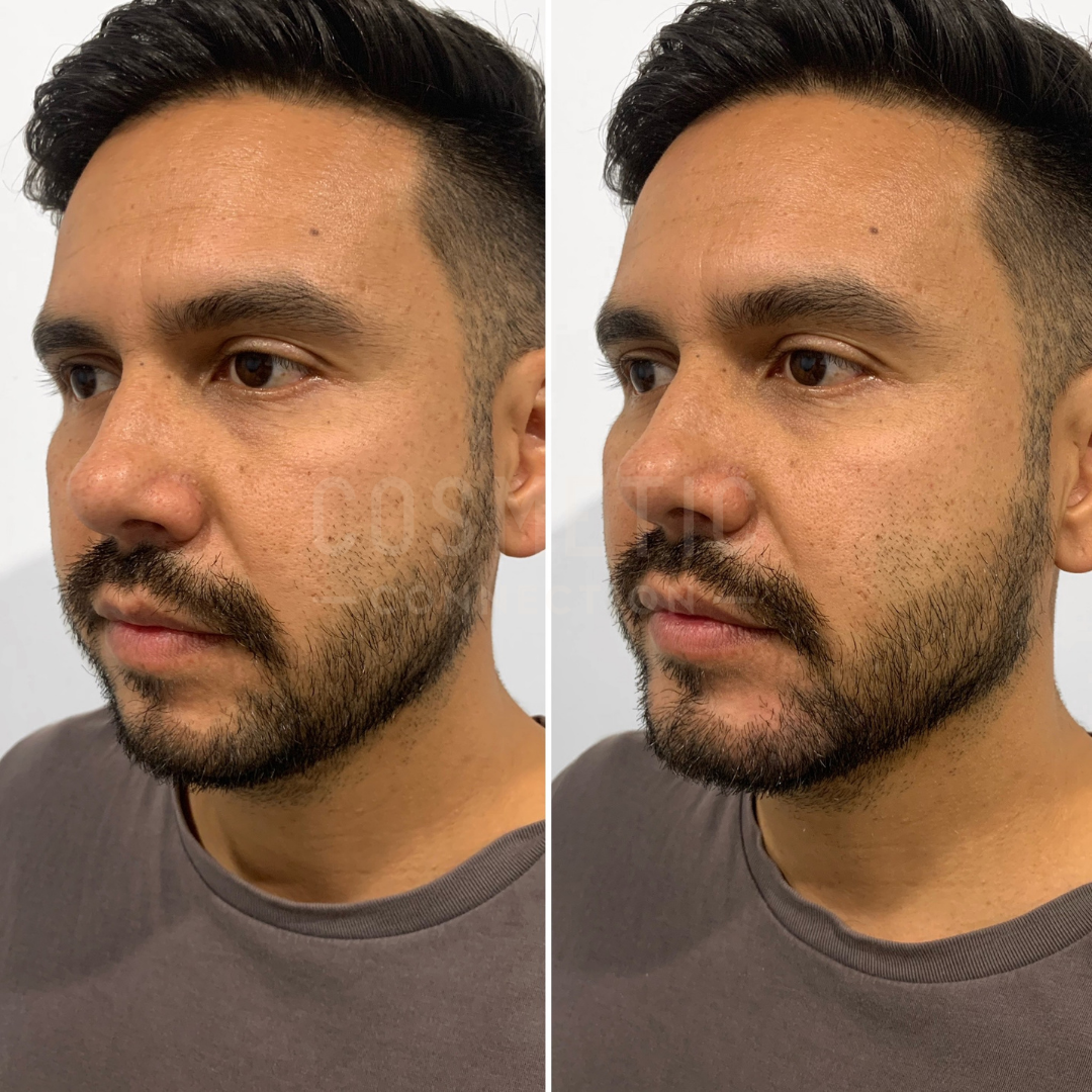 Side-by-side images of a man with a beard and a neutral expression, showing a subtle difference in skin texture and tone. The lighting is consistent in both images, highlighting the complexion.