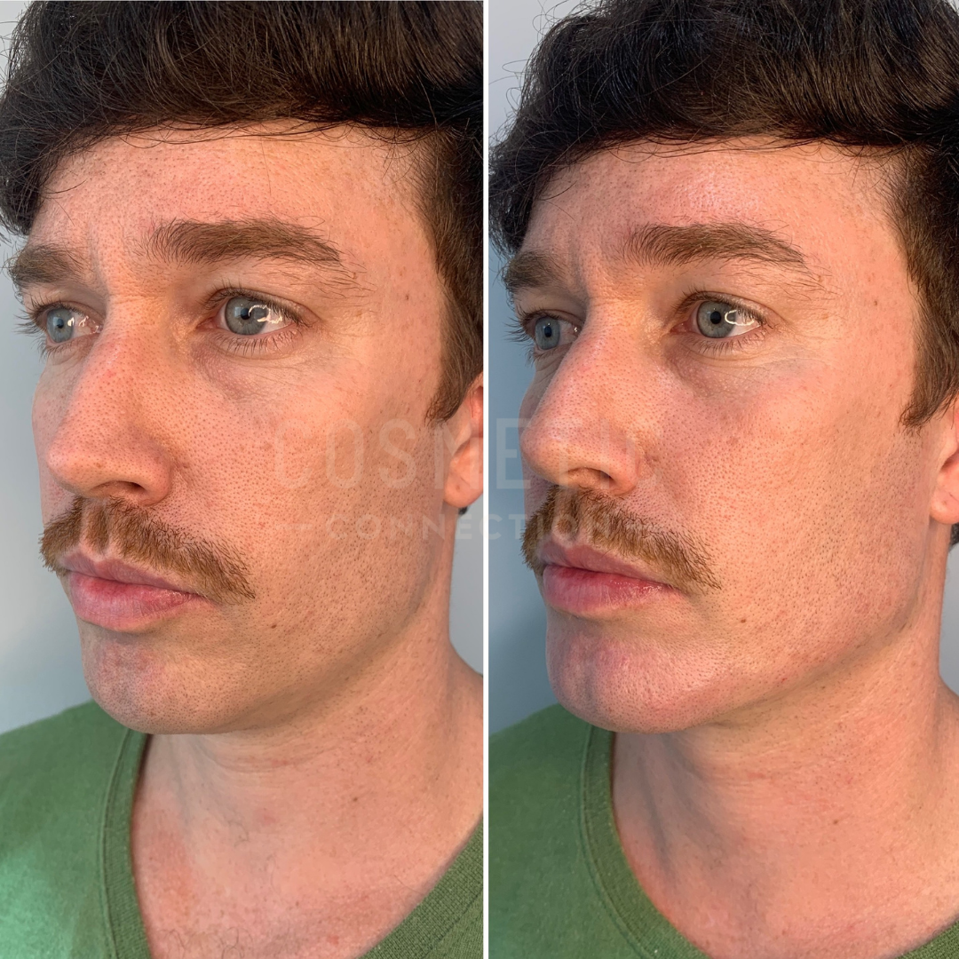 Side-by-side comparison of a person before and after receiving facial treatment. Both images show the person with a slight mustache and wearing a green shirt, highlighting improvements in skin appearance.
