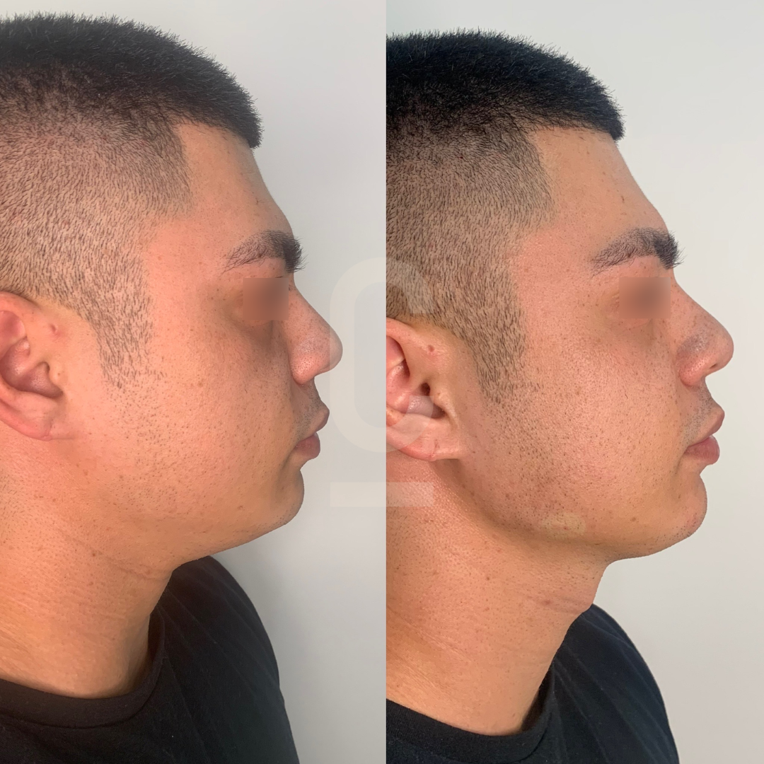 Side-by-side profile views of a man before and after cosmetic surgery. The left image shows him with a fuller chin, and the right shows a more defined jawline and chin. Both images feature the man against a plain background.