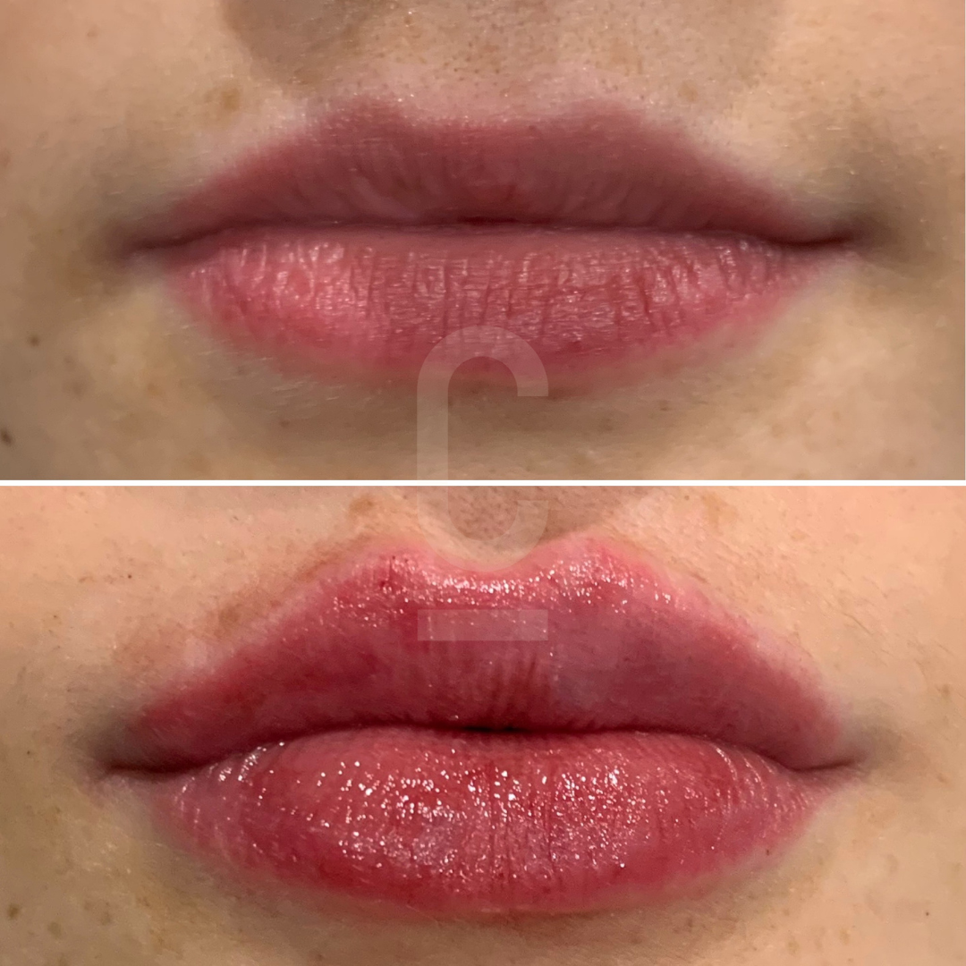 A before-and-after comparison of lips. The top image shows natural, unadorned lips, while the bottom image displays lips with a glossy, slightly more defined appearance.