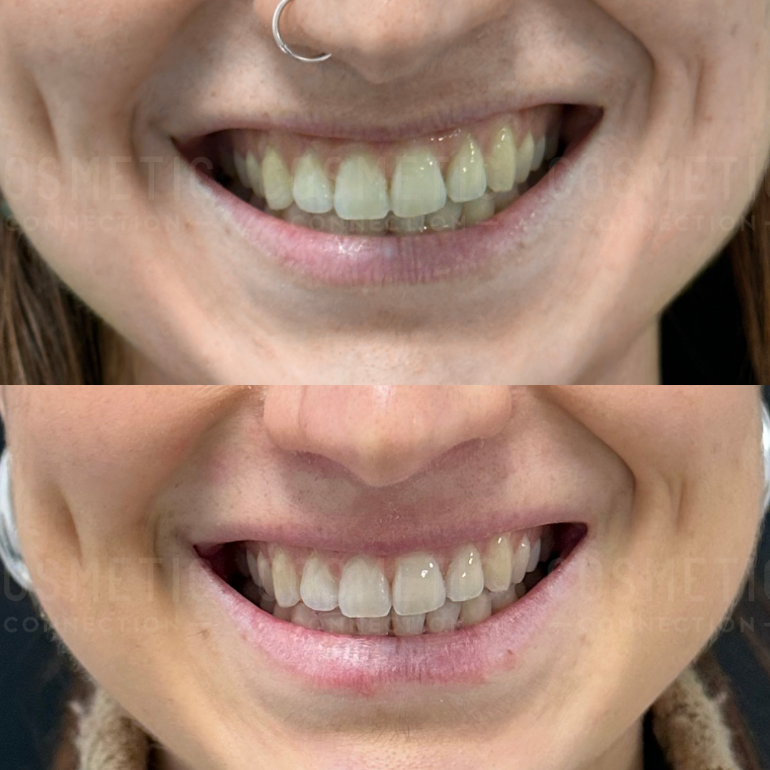 Close-up of a persons mouth showing teeth in two images, one above the other. The top image displays teeth before a dental procedure, and the bottom image shows brighter, more aligned teeth after treatment.