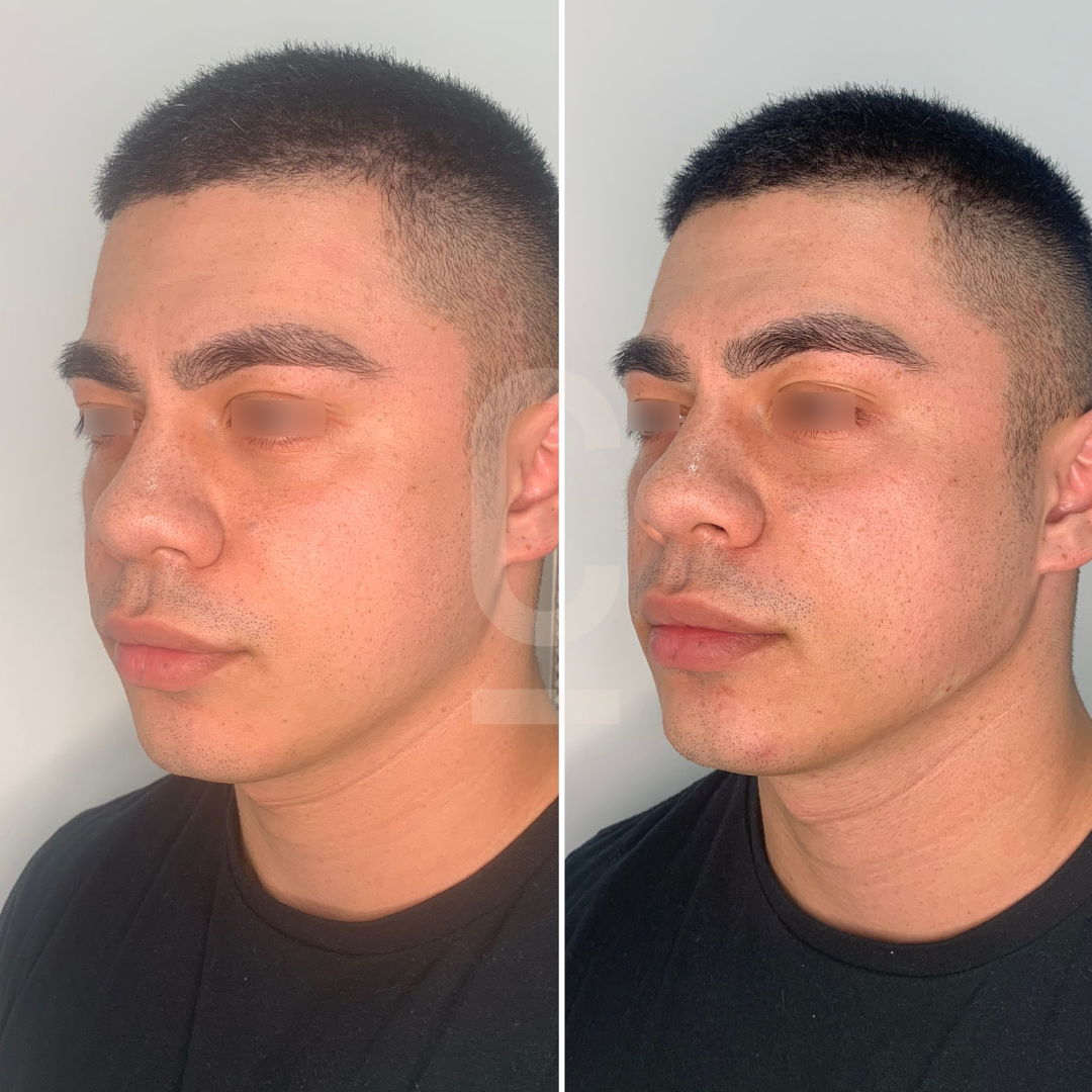 Side-by-side images of a person with short, dark hair. The first image shows a profile view, and the second image, slightly turned, highlighting facial features and subtle differences in lighting. The person is wearing a black shirt.