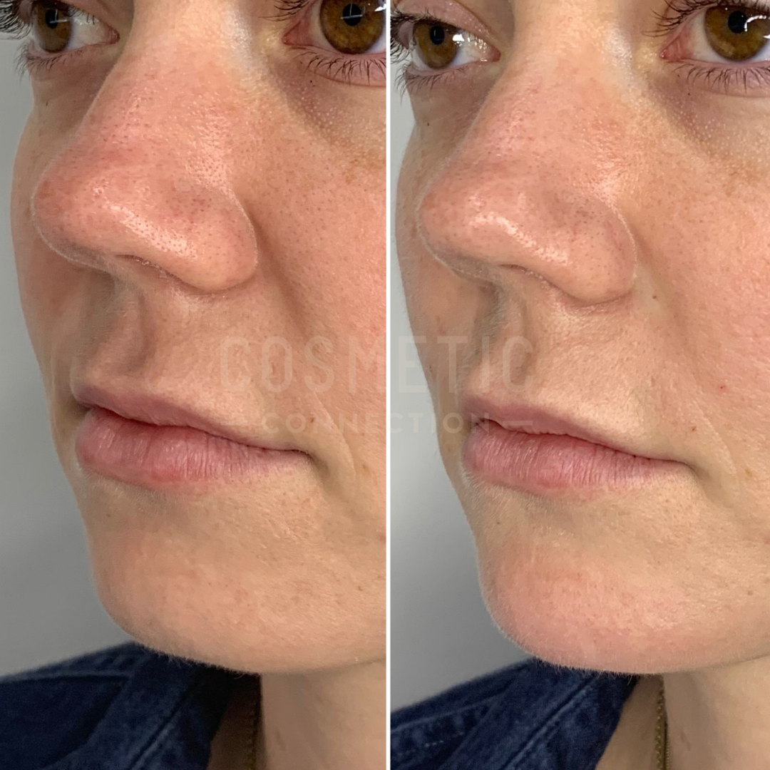 Close-up side-by-side images of a persons face showing before and after skincare treatment. The after image appears to show smoother skin.