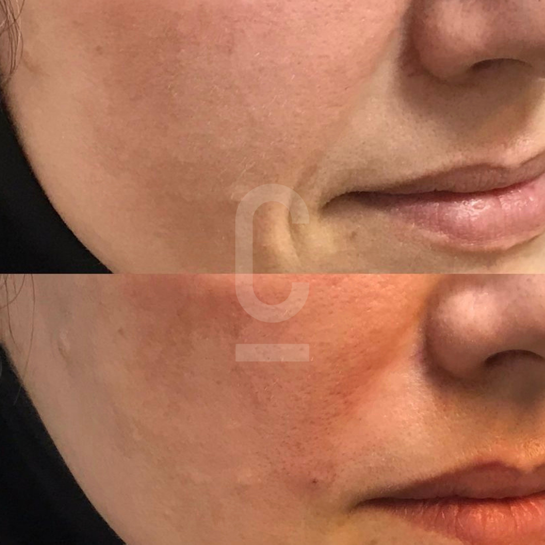 Close-up images of a persons cheek and mouth area before and after a treatment. The top image shows smoother and lighter skin, while the bottom image shows redness and some texture.