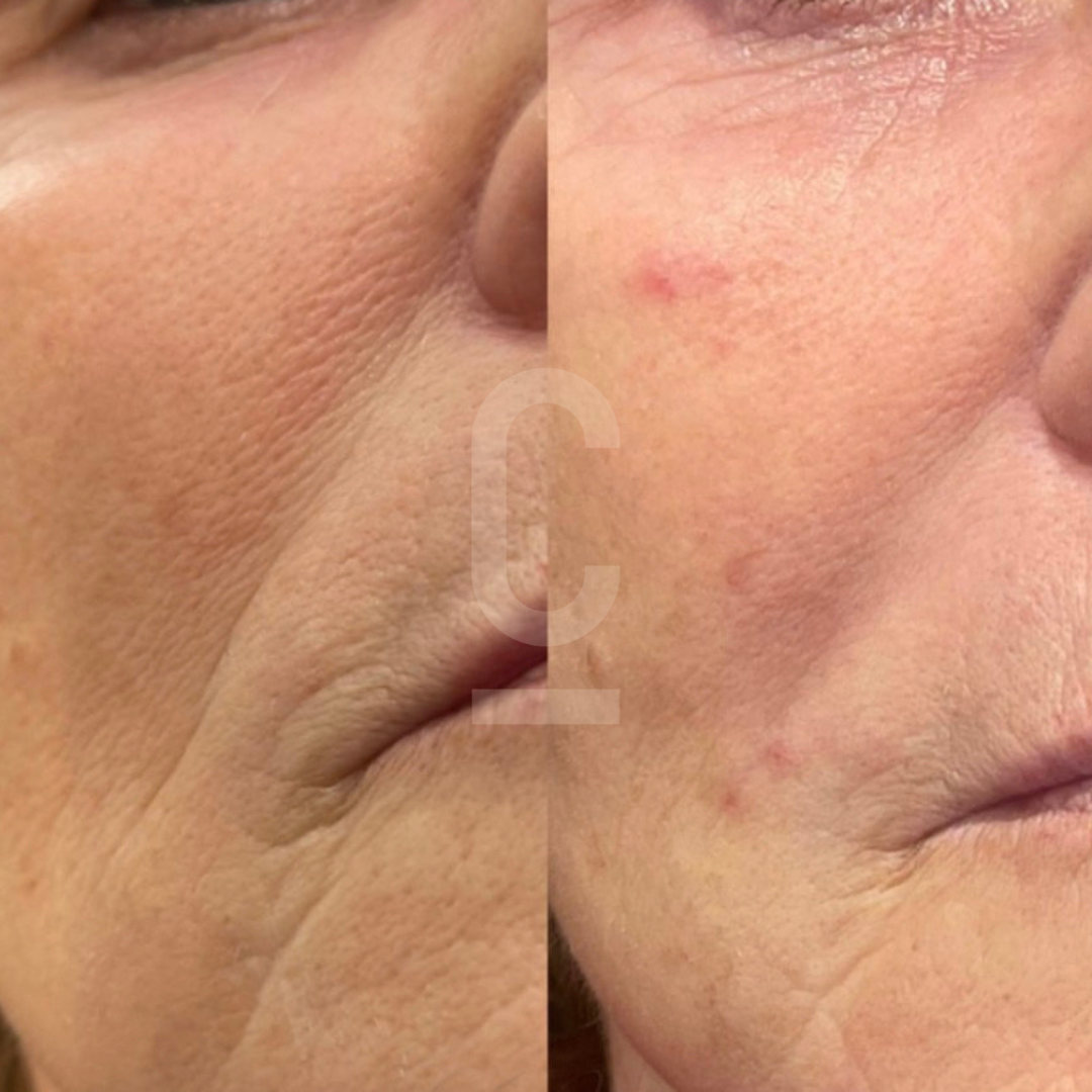 Close-up comparison of a persons skin texture on the left and right sides of the image. The left side shows smoother, more even skin, while the right side displays slightly more textured skin with some redness and blemishes.