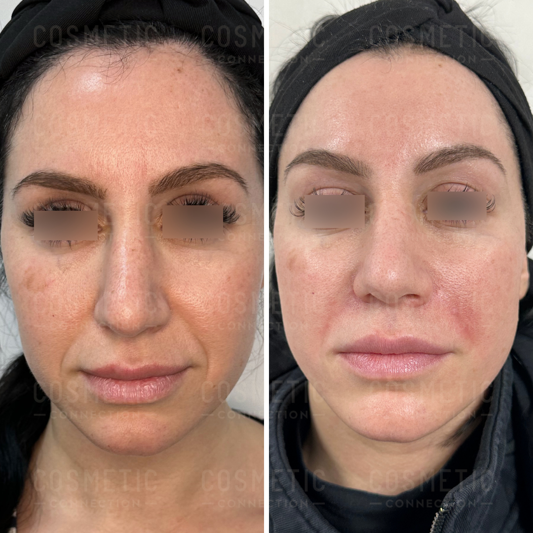 Side-by-side images of a womans face before and after a cosmetic procedure. The left image shows her with smooth skin, and the right image shows her with slightly reddish skin. Both images have areas of the eyes obscured.