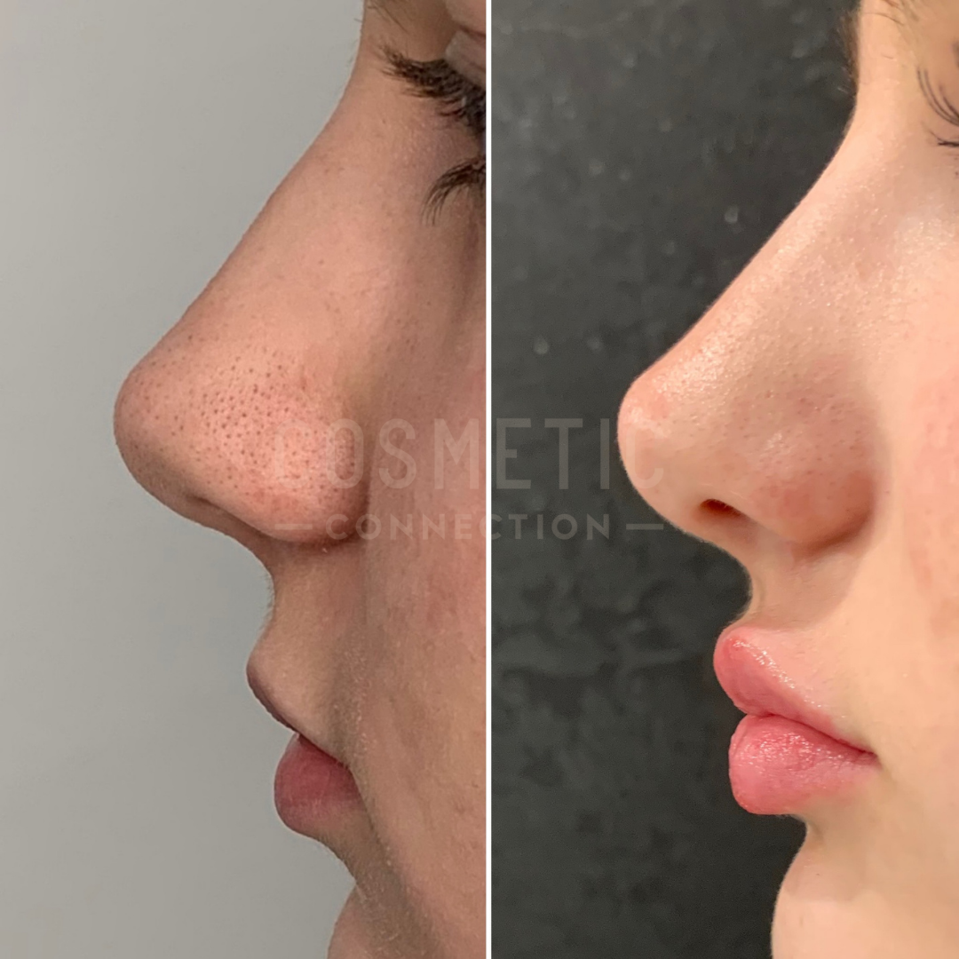 Side-by-side profile photos of a persons nose and lips showing a before and after comparison from a cosmetic procedure. The left image shows blackheads and uneven skin texture, while the right shows smoother skin and an altered nose shape.