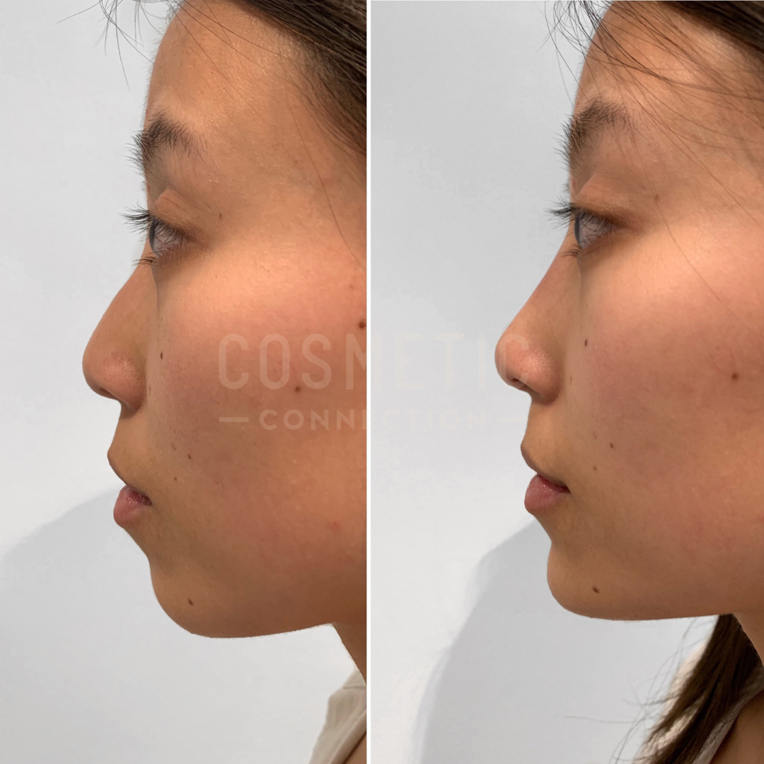 Side-by-side profile views of a person before and after a cosmetic procedure, showing adjustments to the nose and chin areas. The left image shows the pre-procedure profile, and the right image shows the post-procedure profile.