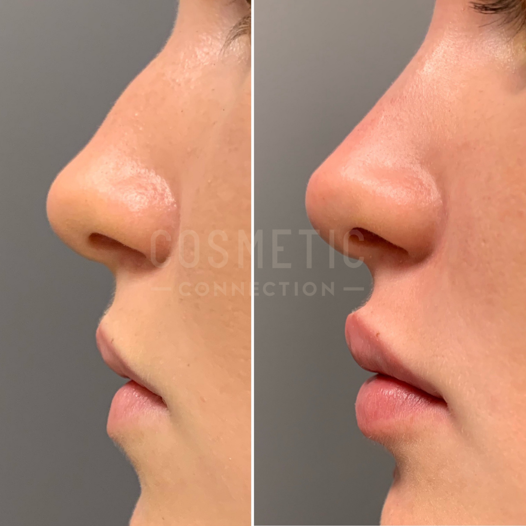 Side-by-side comparison of a persons nose and lips before and after cosmetic treatment. The left image shows the original profile, and the right image displays a visibly refined nose and fuller lips.