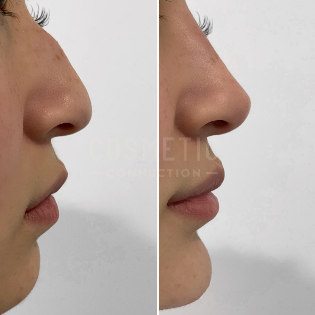 Side-by-side comparison of a persons profile before and after a cosmetic procedure. The left image shows the nose and lips before, while the right image shows the nose and lips after. Both images highlight subtle changes.