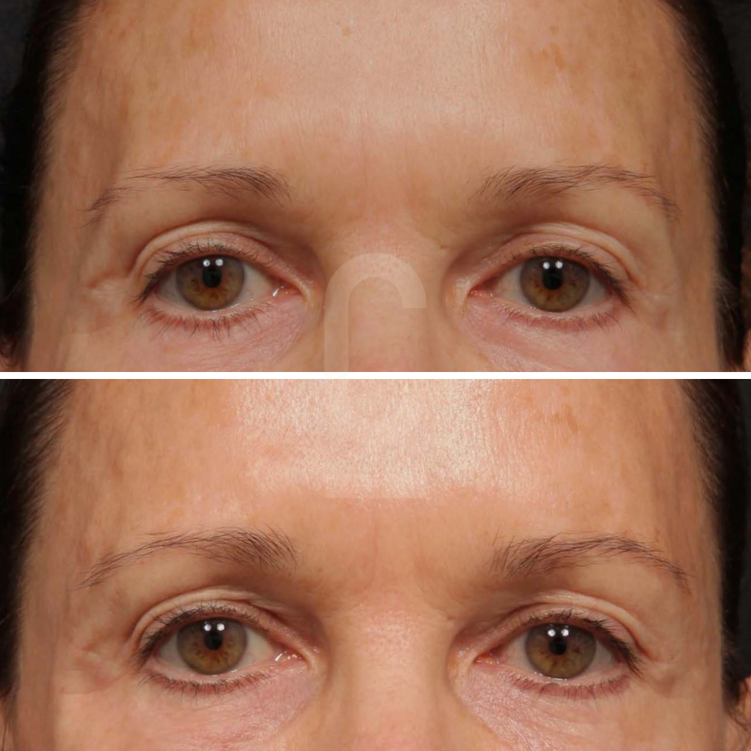 Close-up images of a persons eyes, showing a before and after comparison. The top image has more prominent age spots and wrinkles, while the bottom image shows smoother skin and reduced spots around the eyes.