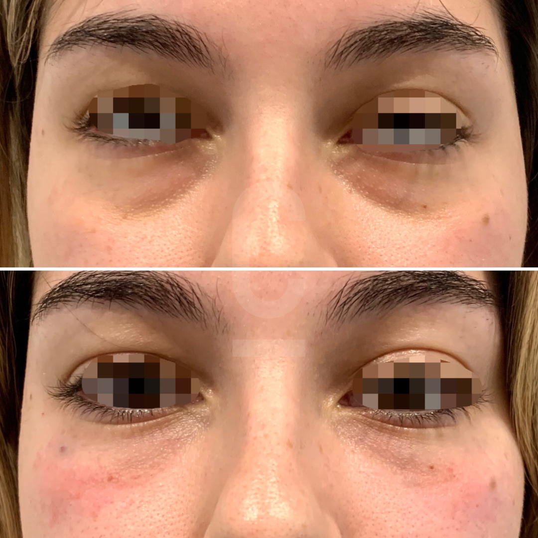 Two close-up images showing the eye area of a person. The top image displays slight under-eye puffiness and darker circles, while the bottom image shows reduced puffiness and a lighter complexion around the eyes.