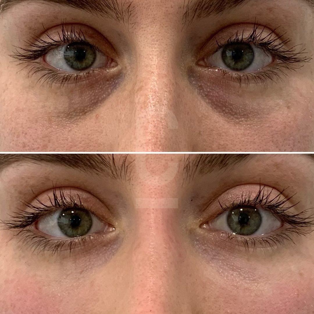 Close-up of a person’s eyes, shown in two images. The top image displays the eyes with noticeable dark circles, while the bottom image shows a reduction in dark circles and a brighter appearance.