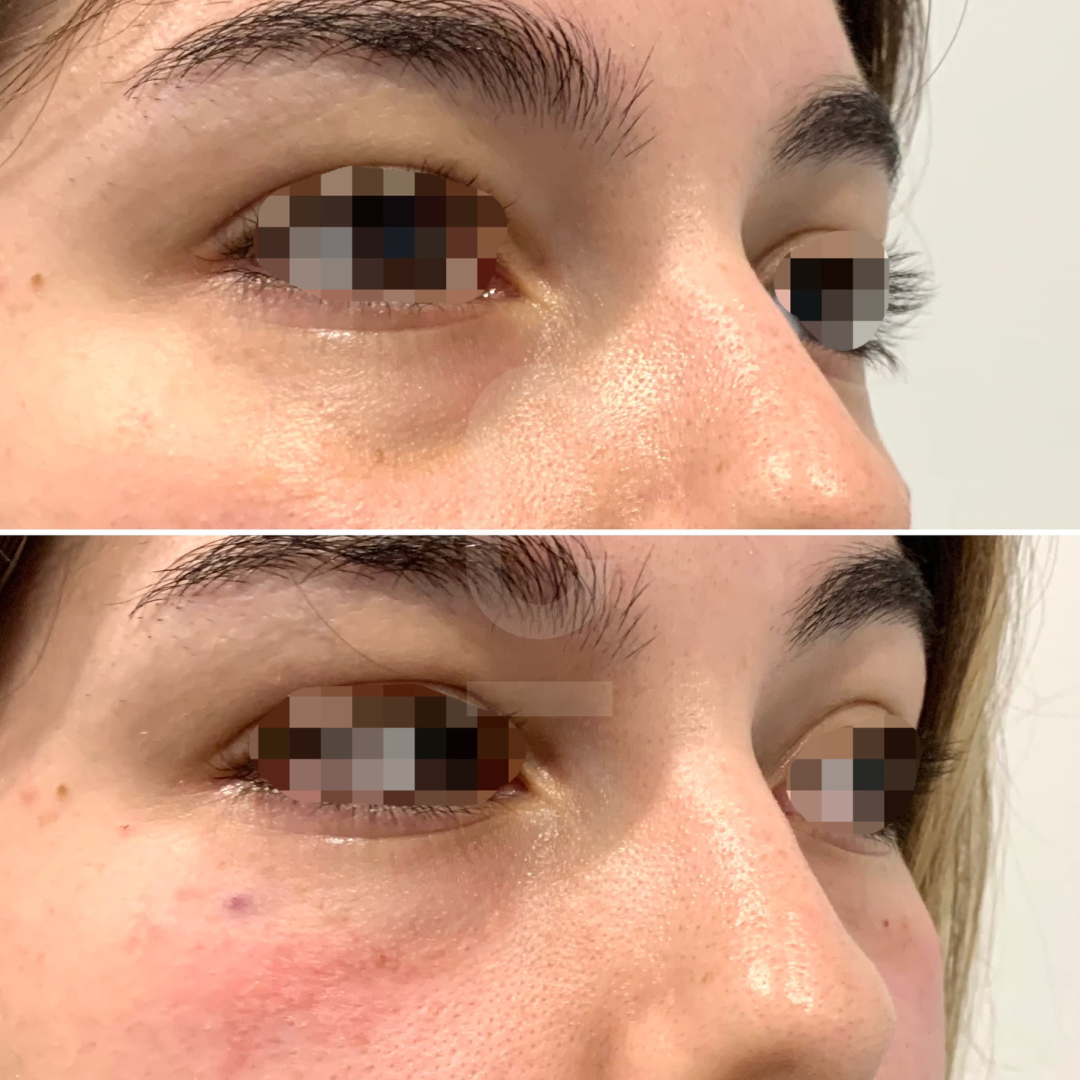 Split image showing a close-up of a persons eyes, with visible changes in skin texture and appearance around the eyes. The top and bottom images depict before-and-after effects, emphasizing a fresher look in the latter.
