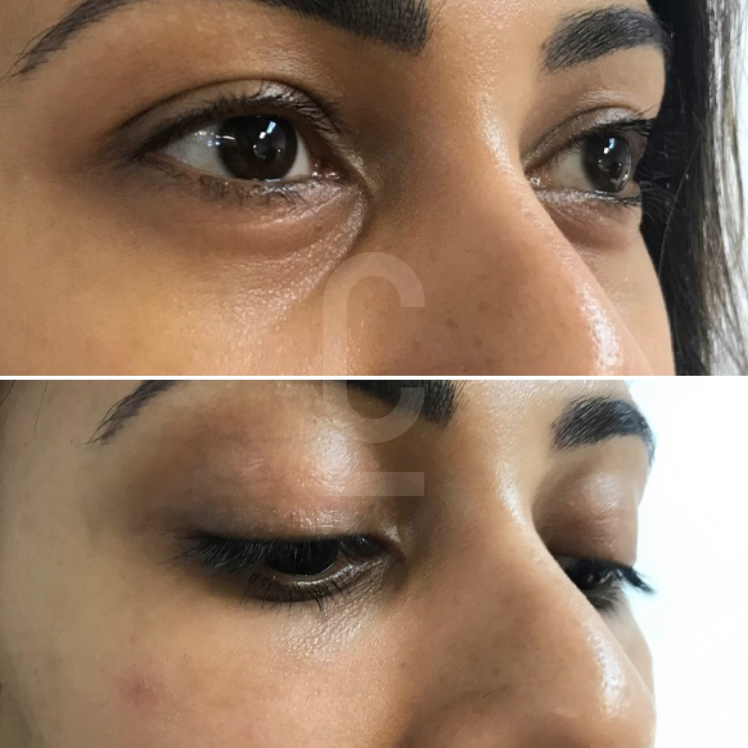 Close-up images of a persons eyes. The top image shows the eyes open, while the bottom image shows them closed. The skin and eyebrows are visible, highlighting natural features and eyelids.