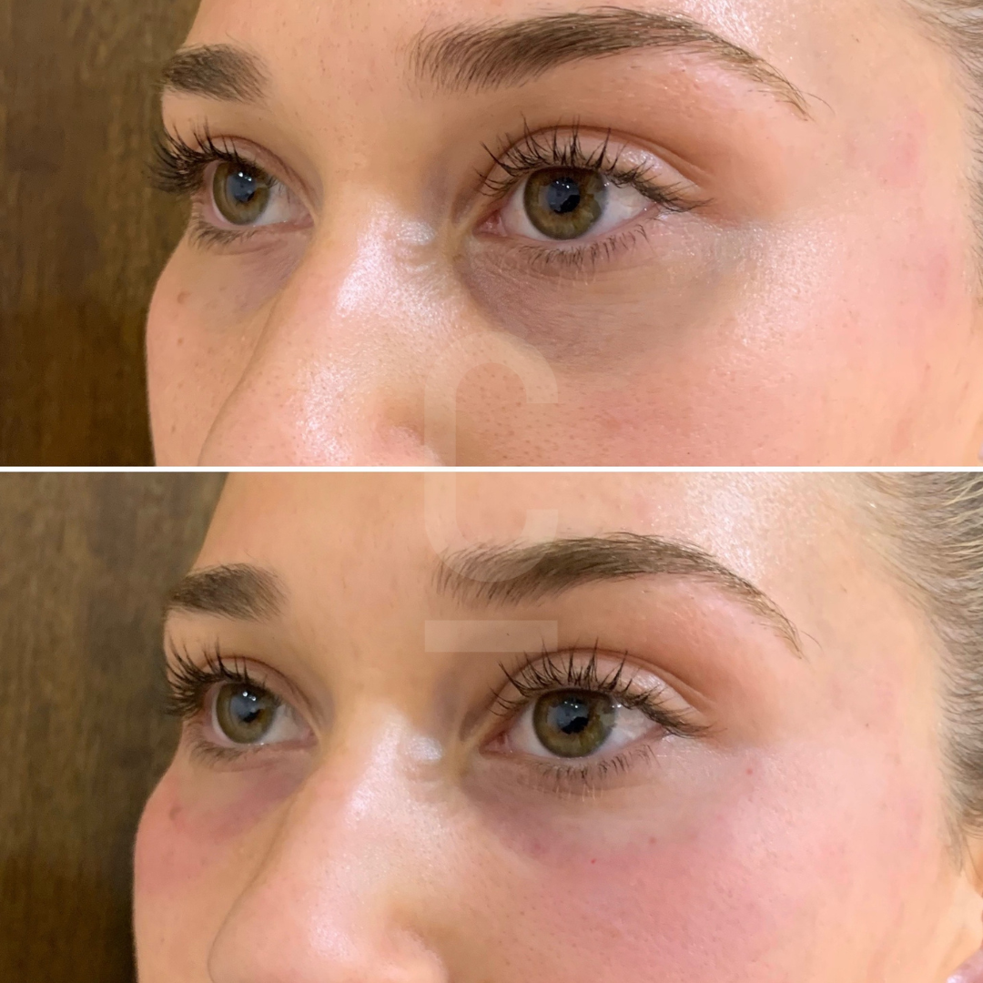 Close-up of a persons face showing the eye area in two images. The top image features prominent dark circles and fine lines, while the bottom image shows a noticeable reduction in shadows and smoother skin.
