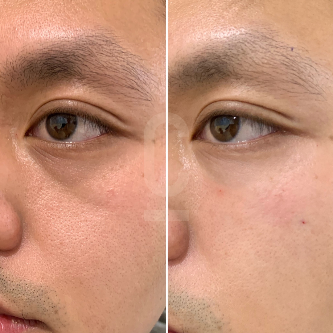 Close-up of a persons face showing a side-by-side comparison: the left side features noticeable under-eye bags and skin texture, while the right side shows smoother skin and reduced eye bags.