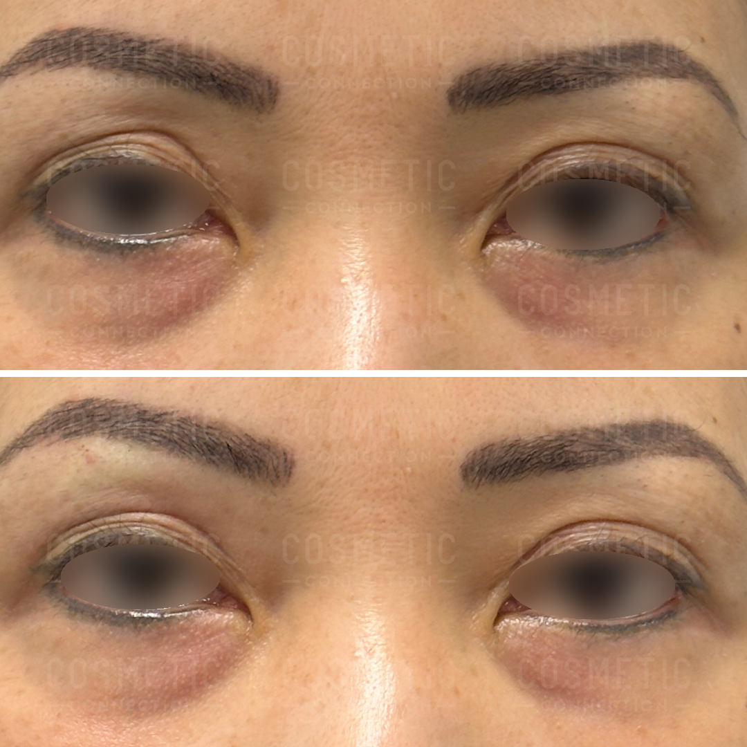 Close-up of a persons eyes shows a comparison before and after a cosmetic procedure. The top image displays more prominent under-eye bags and darker circles, while the bottom image shows reduced bags and lighter circles, indicating improvement.