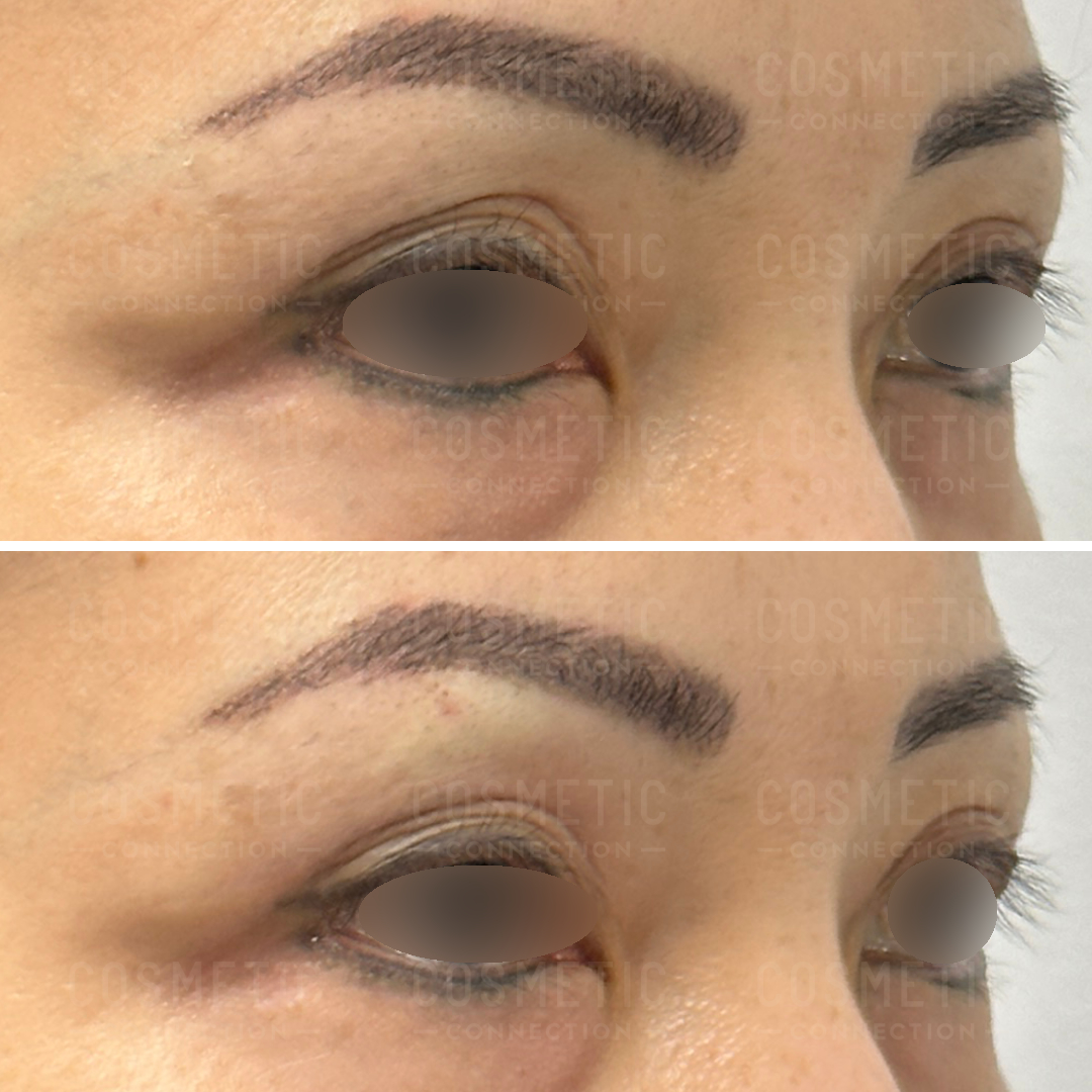 Close-up of a face showing side-by-side comparison of an eyebrow tattoo. The top image shows the original eyebrows, and the bottom image shows the eyebrows after tattoo enhancement, appearing fuller and more defined. Eyes are obscured for privacy.