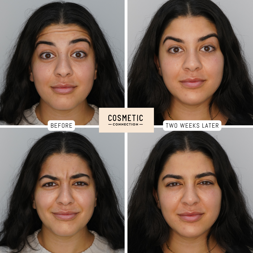 Four photos show a woman before and after a cosmetic treatment. Top left and bottom left images are labeled Before, with visible facial lines. Top right and bottom right images are labeled Two Weeks Later, with smoother skin and more relaxed expressions.