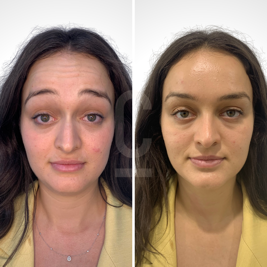Comparison of a woman with long dark hair in two side-by-side photos. On the left, her face shows redness and slight under-eye bags. On the right, her complexion appears smoother and more even-toned, with reduced redness and under-eye appearance.